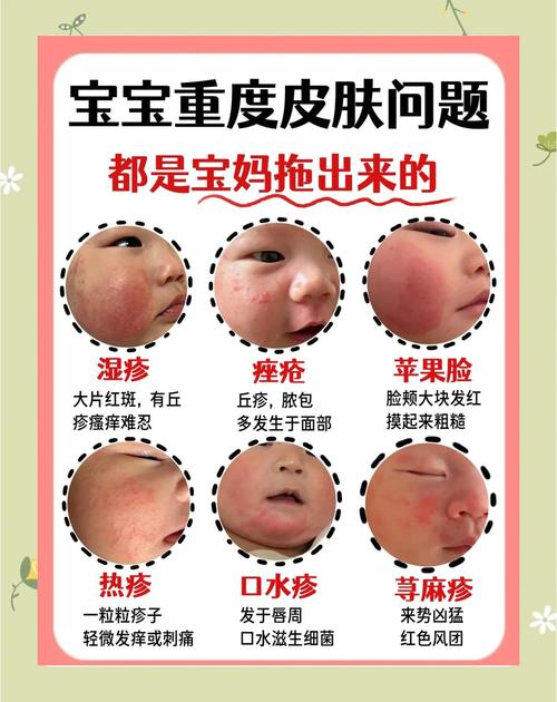新生儿皮肤发红是正常生理现象还是疾病信号？需如何护理与观察？-第3张图片-郑州医学网