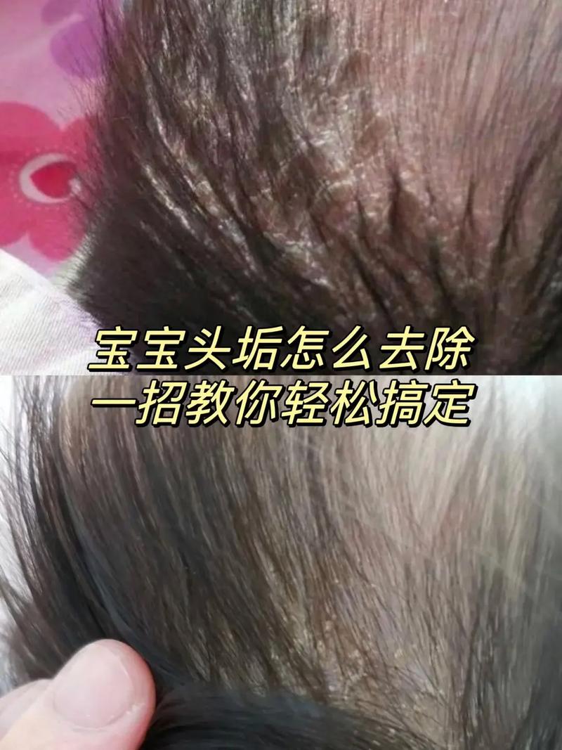 新生儿毛发浓密需要剃吗？会不会影响后续发育？护理时要注意什么？-第1张图片-郑州医学网