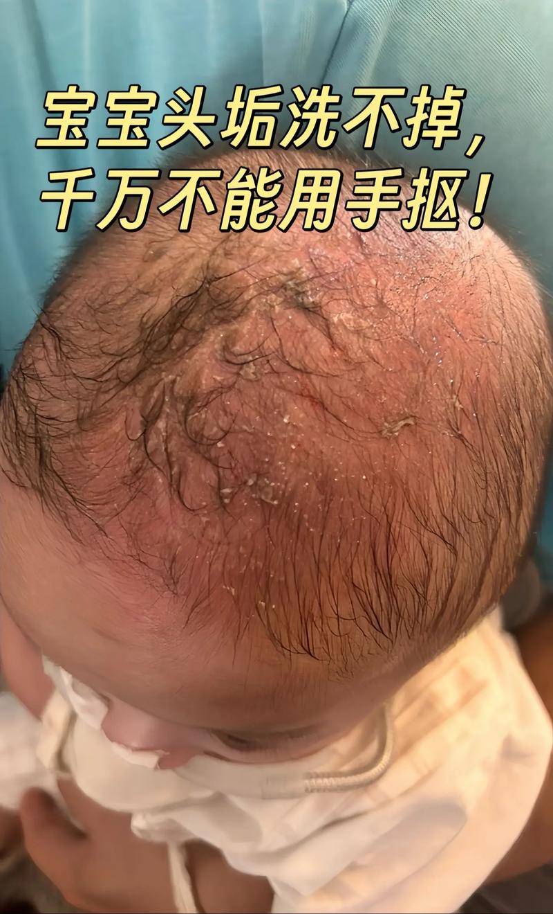 新生儿毛发浓密需要剃吗？会不会影响后续发育？护理时要注意什么？-第3张图片-郑州医学网