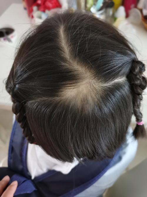 新生儿头顶为何会掉头发?是正常生理现象还是异常信号?-第1张图片-郑州医学网 新生儿头顶为何会掉头发?是正常生理现象还是异常信号?-第1张图片-郑州医学网