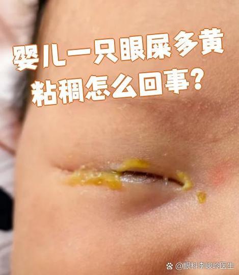 新生儿母乳黄疸眼白黄-第3张图片-郑州医学网