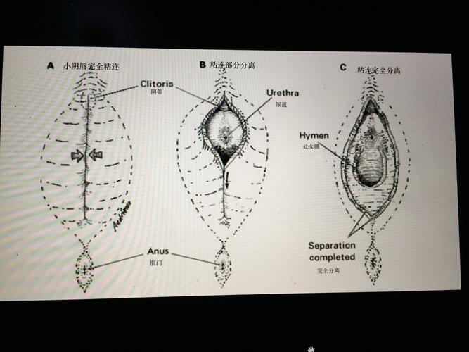 新生儿大阴唇红肿图片是正常现象吗？需要就医吗？-第3张图片-郑州医学网