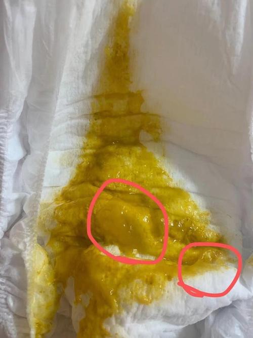 新生儿吃完奶就拉屎是消化不良还是正常生理反应？-第3张图片-郑州医学网