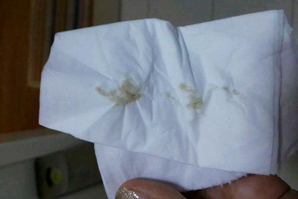 孕期咖啡色分泌物图片，是先兆流产还是正常生理现象？-第1张图片-郑州医学网