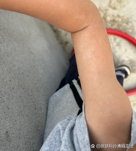 新生儿几个月皮肤会自然变白？影响肤色变化的关键因素有哪些？-第1张图片-郑州医学网