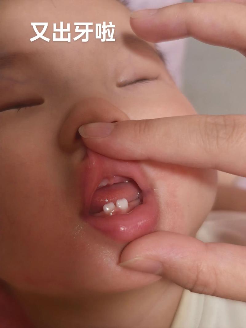 新生儿出牙前牙床图片是什么样子？正常状态和异常表现如何区分？-第2张图片-郑州医学网