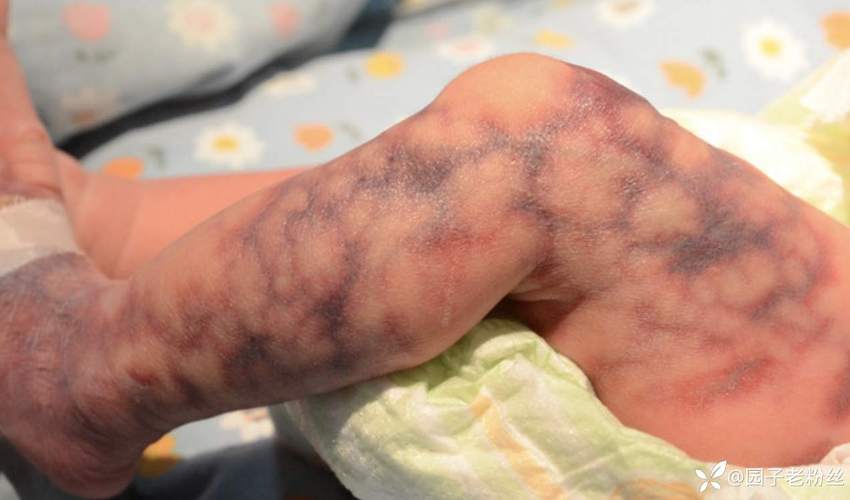新生儿葡萄酒色斑图片-第2张图片-郑州医学网
