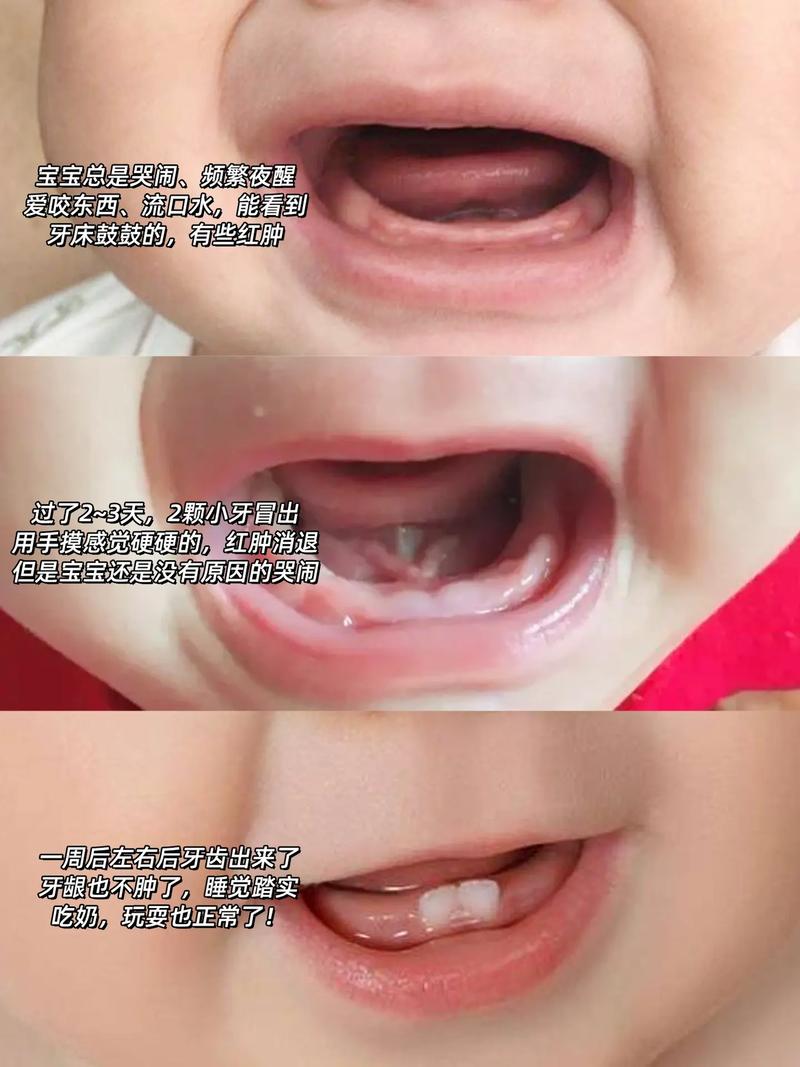 新生儿牙龈肿大是正常现象吗？需要干预吗？-第1张图片-郑州医学网