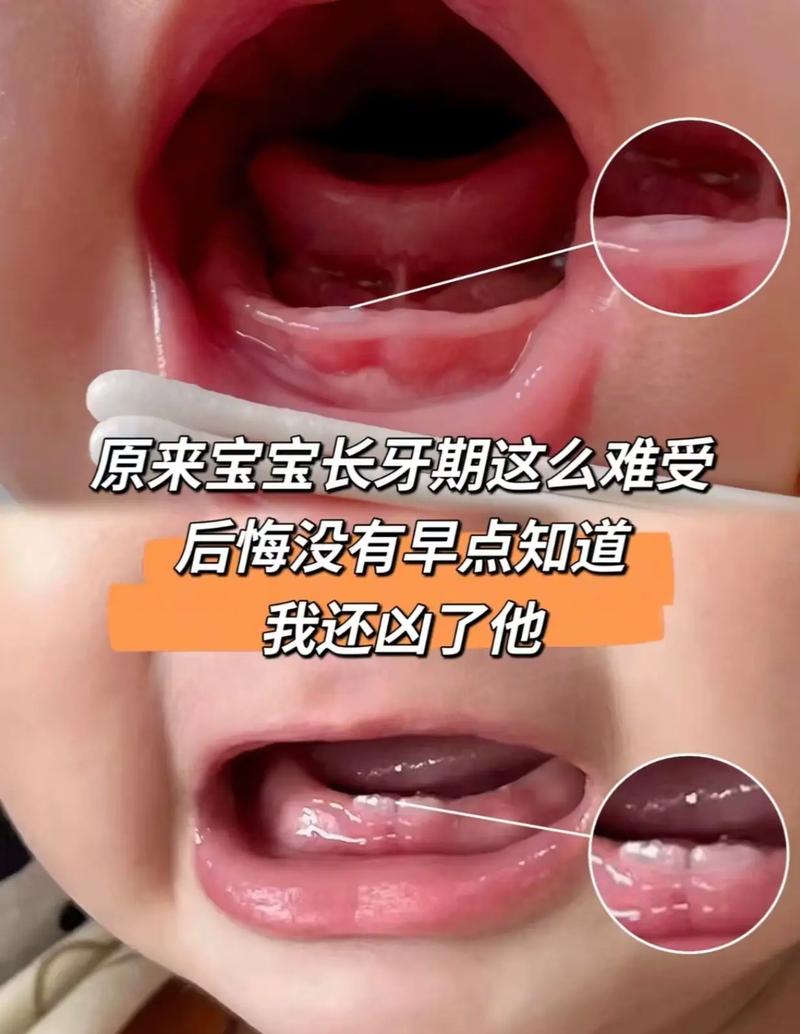 新生儿牙龈肿大是正常现象吗？需要干预吗？-第2张图片-郑州医学网