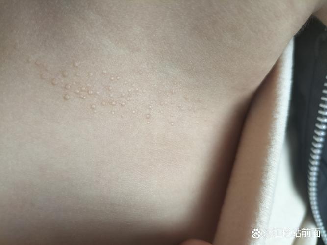 儿童身上起小米粒疙瘩是过敏还是皮肤病？需要怎么处理？-第1张图片-郑州医学网