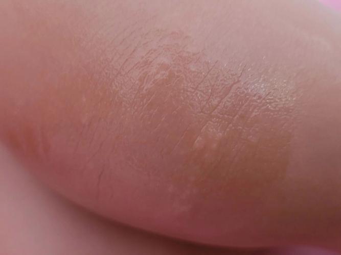 儿童身上起小米粒疙瘩是过敏还是皮肤病？需要怎么处理？-第2张图片-郑州医学网