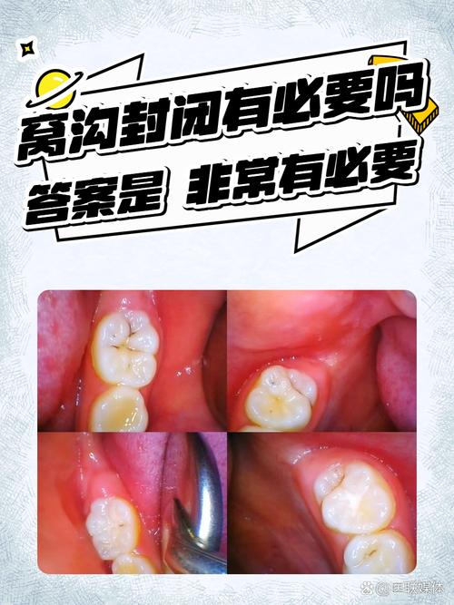 儿童窝沟封闭到底有没有必要做？真的能防蛀牙吗？-第2张图片-郑州医学网