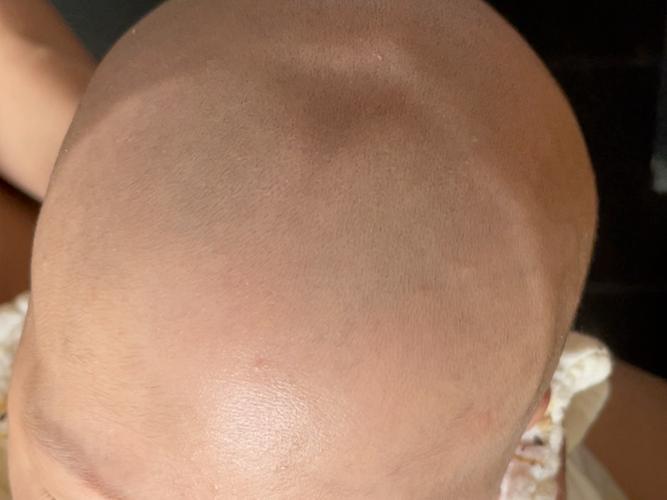 新生儿后囟门具体位于头部哪个位置？何时闭合才正常？-第1张图片-郑州医学网