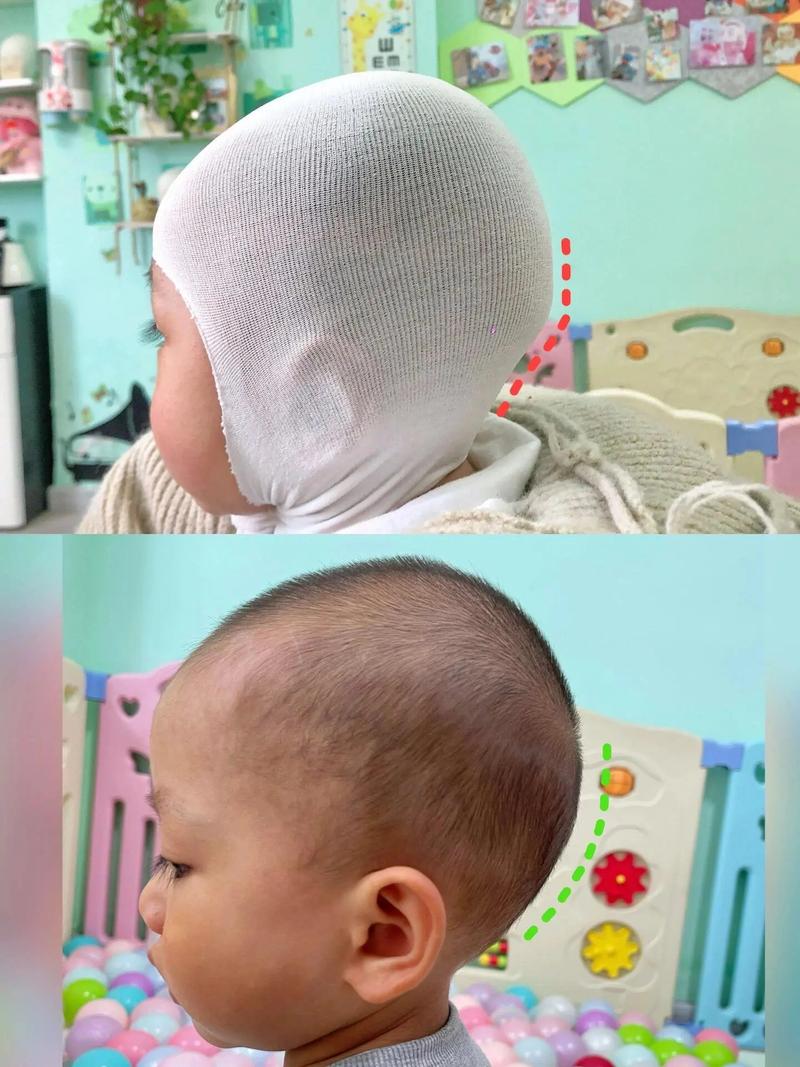 新生儿头骨突出是正常现象吗？需要担心什么问题？-第1张图片-郑州医学网