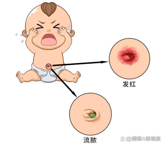 新生儿肚脐发红是感染了吗？该如何正确护理处理？-第2张图片-郑州医学网