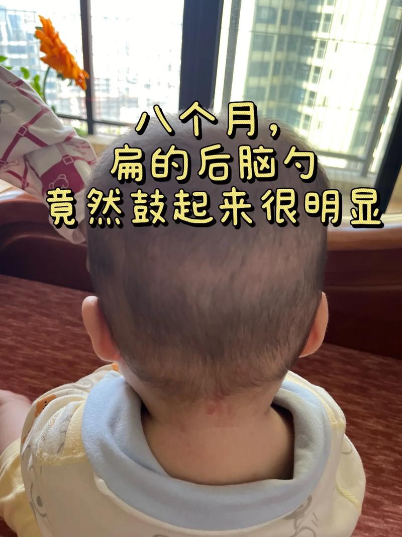 新生儿后脑勺骨头凸起是正常生理现象还是需要警惕的异常情况？-第1张图片-郑州医学网