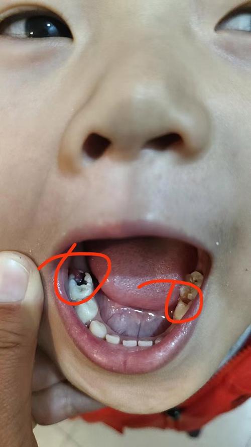 儿童做根管治疗费用受哪些因素影响？具体要花多少钱？-第3张图片-郑州医学网