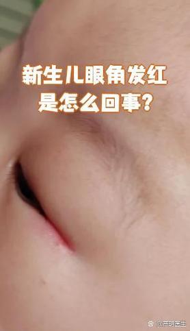 新生儿红眼边是上火还是感染？新手爸妈该如何正确护理与应对？-第1张图片-郑州医学网