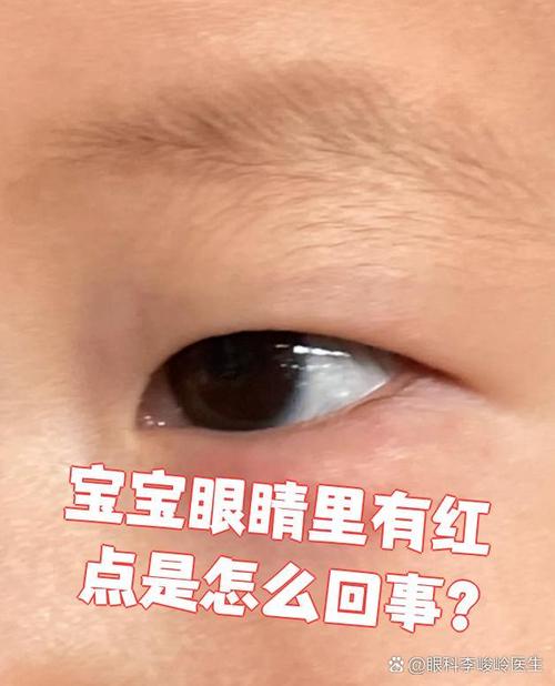 新生儿红眼边是上火还是感染？新手爸妈该如何正确护理与应对？-第2张图片-郑州医学网