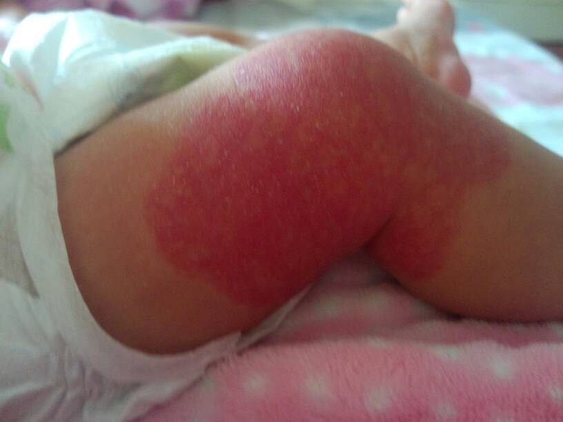 新生儿红色胎记会自行消退吗？如何判断是否需要治疗？-第1张图片-郑州医学网