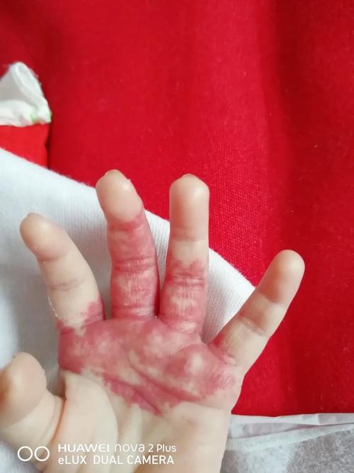 新生儿红色胎记会自行消退吗？如何判断是否需要治疗？-第2张图片-郑州医学网