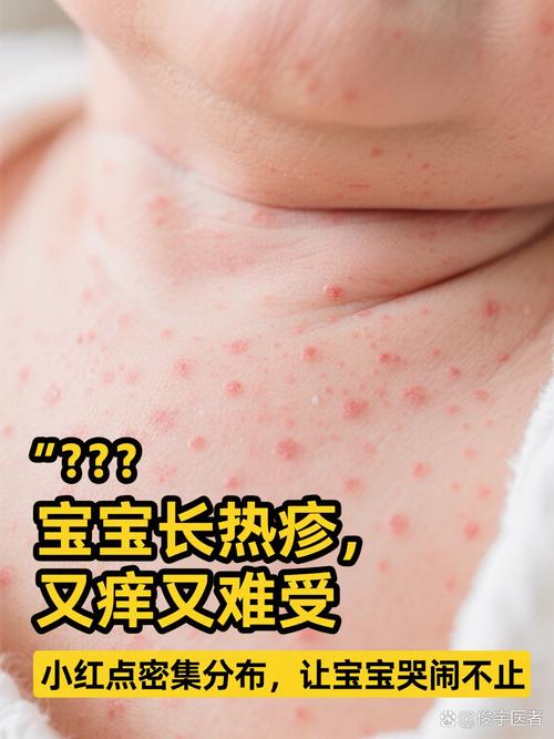 儿童荨麻疹期间洗澡会加重症状吗？水温、沐浴露选择有讲究吗？-第2张图片-郑州医学网