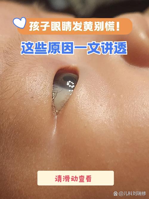 新生儿眼白发黄是黄疸吗？需要就医检查吗？-第1张图片-郑州医学网