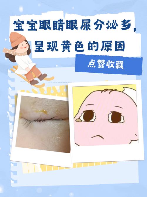 新生儿眼白发黄是黄疸吗？需要就医检查吗？-第2张图片-郑州医学网