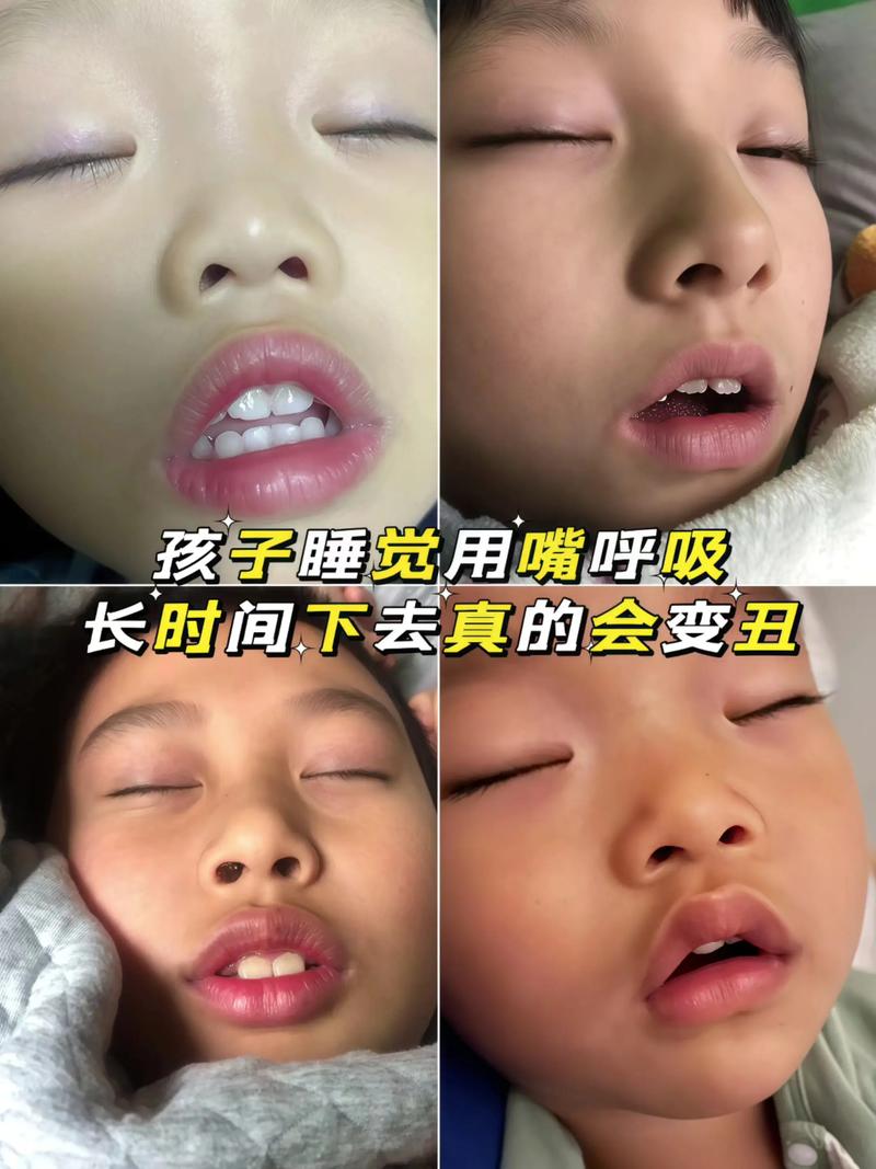 儿童张嘴睡觉怎么回事-第2张图片-郑州医学网 儿童张嘴睡觉怎么回事-第2张图片-郑州医学网