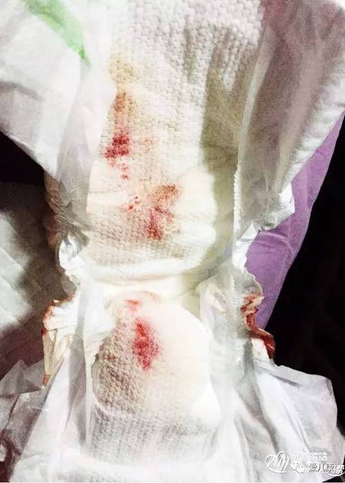 新生儿呕吐褐色分泌物是消化道出血还是正常现象？-第2张图片-郑州医学网