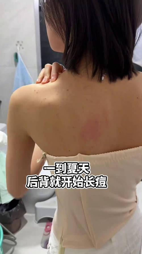 怀孕期间前胸后背长痘是激素变化还是皮肤问题?-第1张图片-郑州医学网 怀孕期间前胸后背长痘是激素变化还是皮肤问题?-第1张图片-郑州医学网