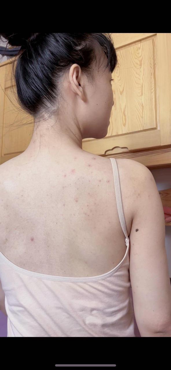 怀孕期间前胸后背长痘是激素变化还是皮肤问题？-第2张图片-郑州医学网