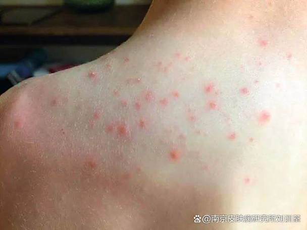 怀孕期间前胸后背长痘是激素变化还是皮肤问题？-第3张图片-郑州医学网