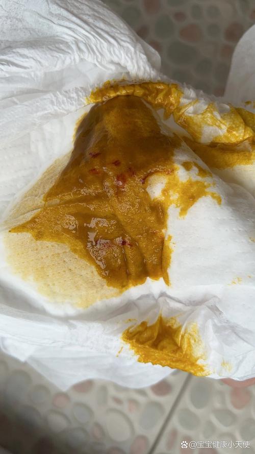 新生儿大便带血是严重信号吗？家长该如何紧急应对？-第2张图片-郑州医学网