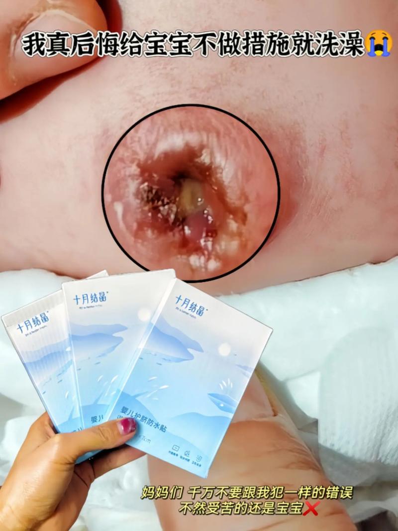 新生儿肚脐眼结痂一直不掉，是正常现象还是需要干预？-第2张图片-郑州医学网