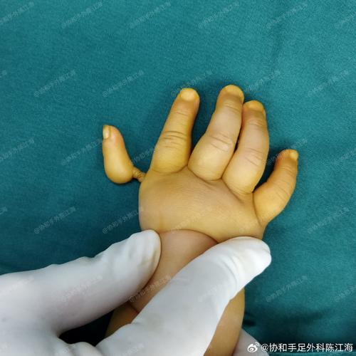 新生儿手足徐动是正常现象吗？需要警惕哪些异常表现？-第1张图片-郑州医学网