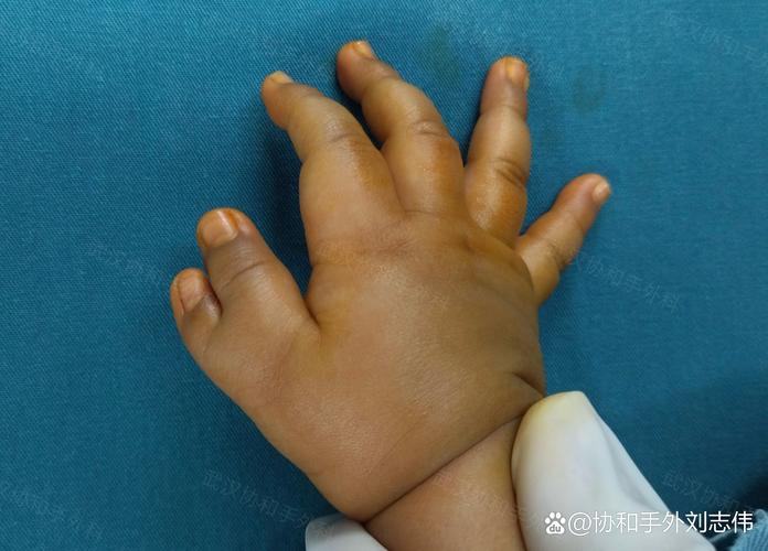 新生儿手足徐动是正常现象吗？需要警惕哪些异常表现？-第2张图片-郑州医学网