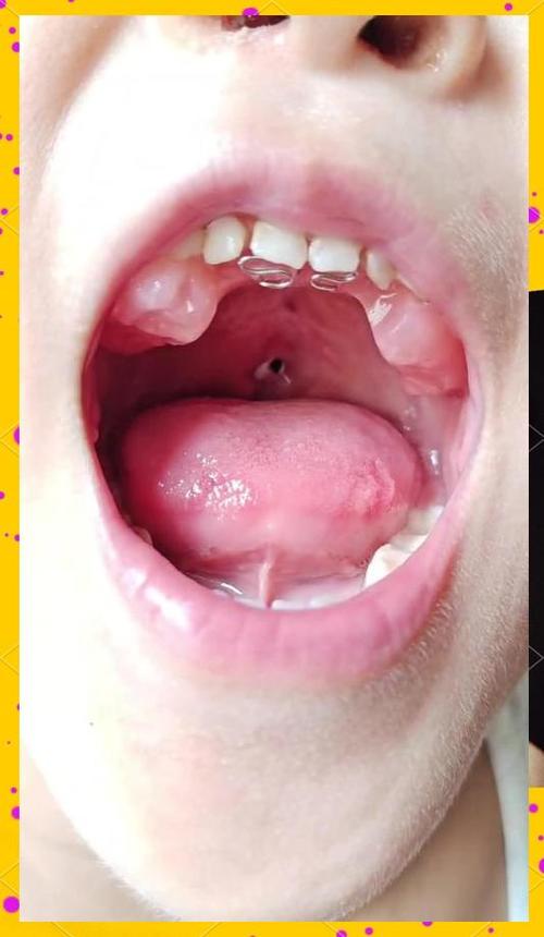 3mm新生儿唇裂照片能看清哪些细节？是否会影响未来修复？-第1张图片-郑州医学网