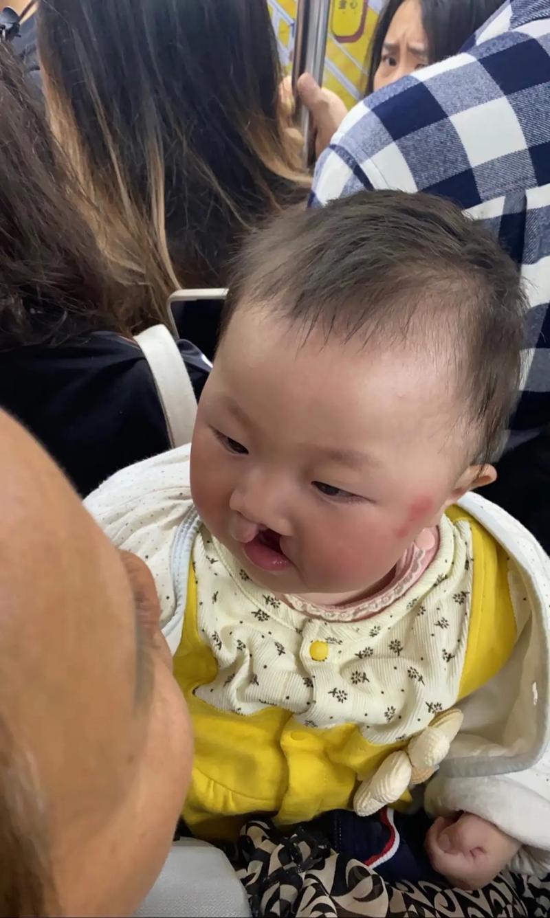 3mm新生儿唇裂照片能看清哪些细节？是否会影响未来修复？-第2张图片-郑州医学网