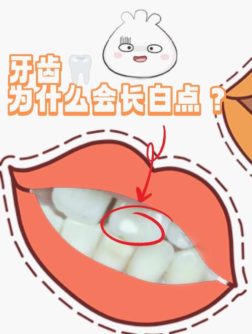 儿童牙齿出现白斑是蛀牙前兆吗？需要怎么处理才能避免恶化？-第2张图片-郑州医学网