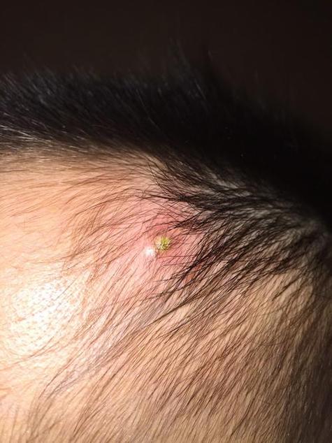 新生儿头上长小白脓泡是正常现象吗？需要担心吗？-第2张图片-郑州医学网