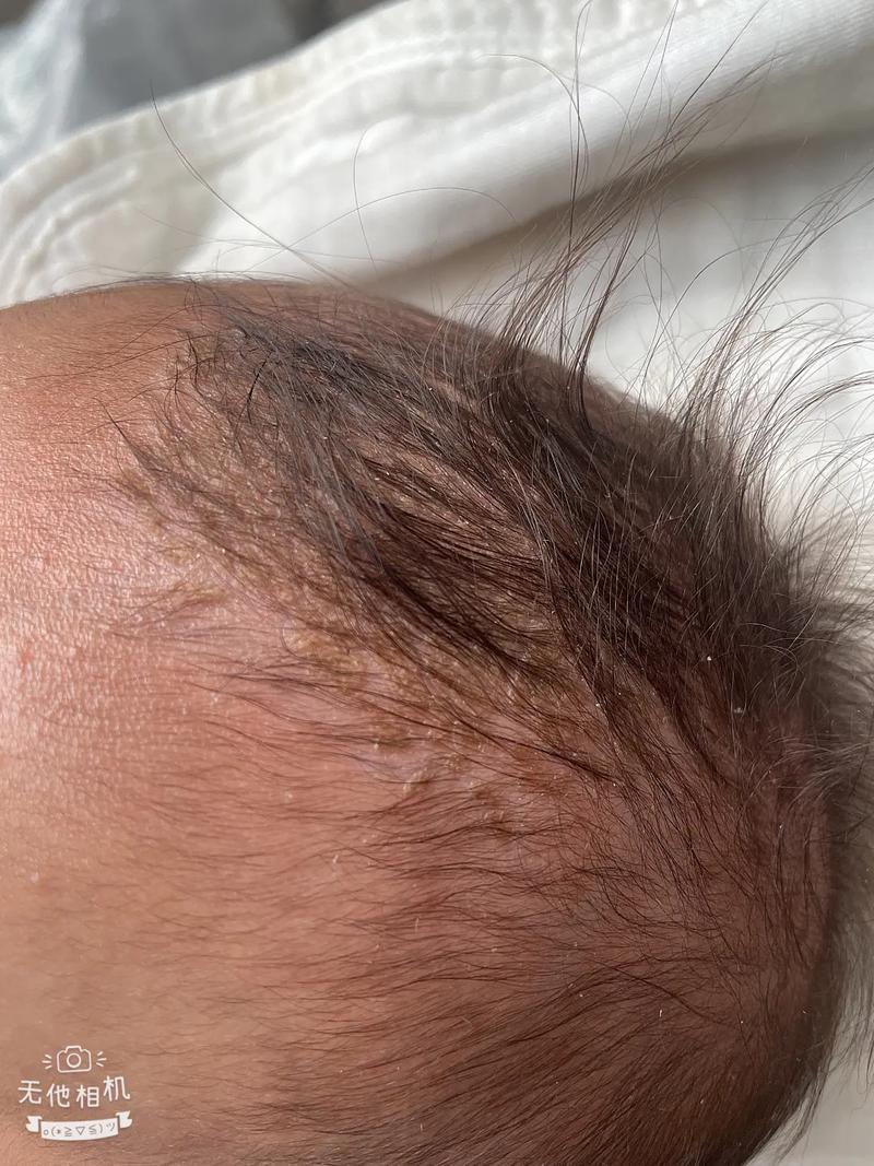 新生儿头上长小白脓泡是正常现象吗？需要担心吗？-第3张图片-郑州医学网
