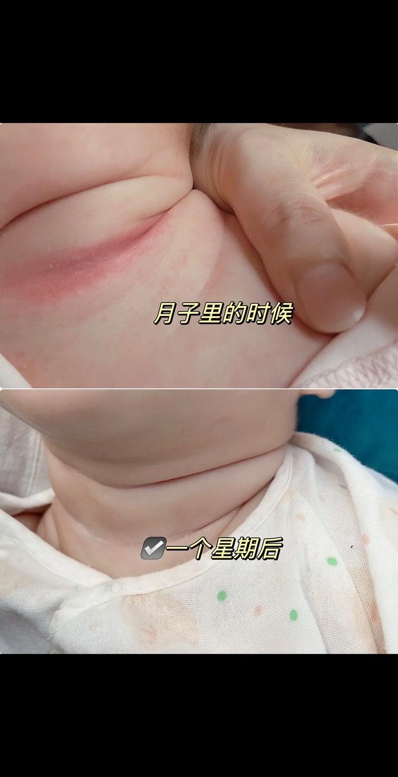 新生儿皮肤娇嫩，破皮后用爽身粉真的安全吗？会不会刺激伤口？-第2张图片-郑州医学网