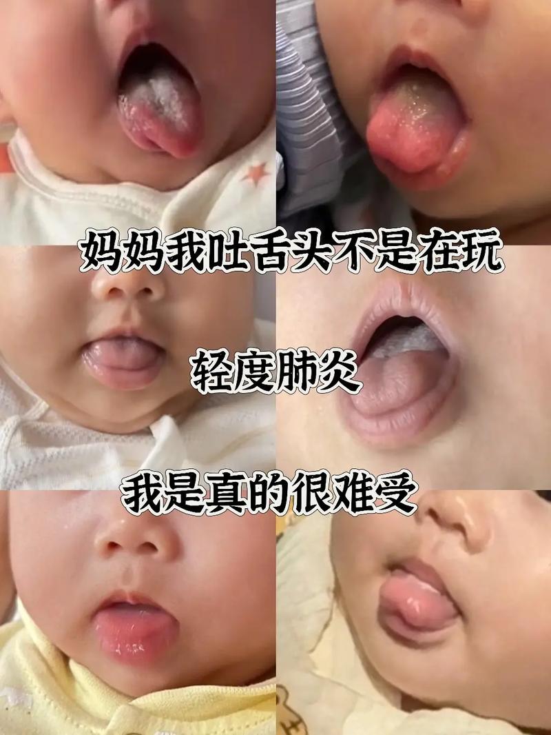 新生儿肺气泡能治好吗？治疗方法与预后效果如何？-第2张图片-郑州医学网