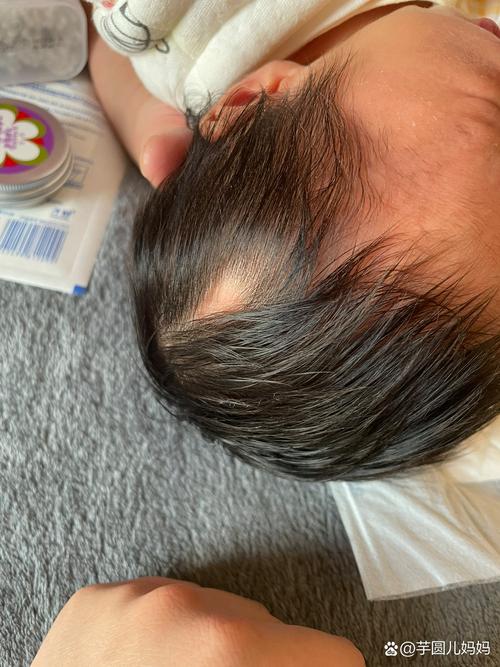 新生儿头顶无发区是正常生理现象还是需要警惕的健康信号？-第1张图片-郑州医学网