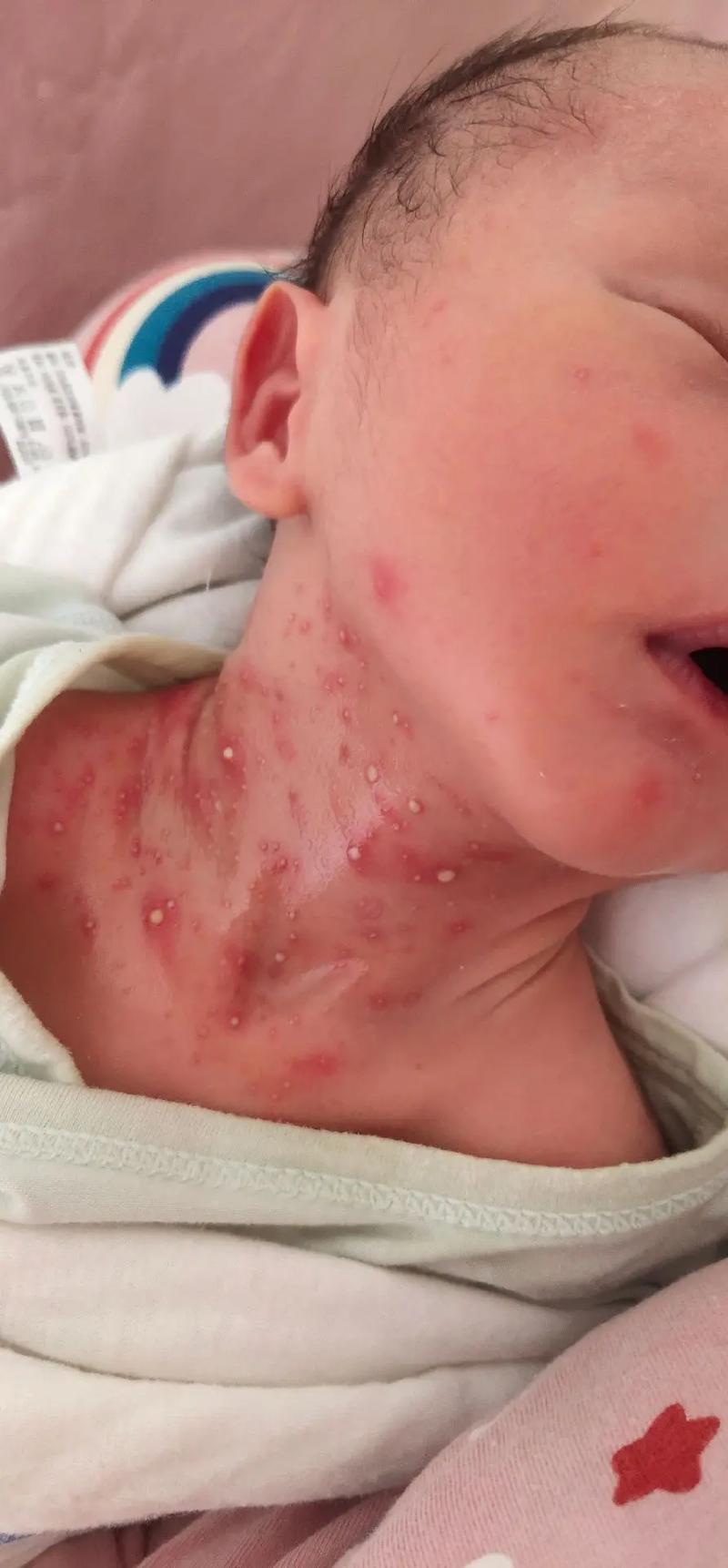 新生儿宝宝脖子长白泡是湿疹还是其他皮肤问题？需要家长如何正确护理？-第1张图片-郑州医学网