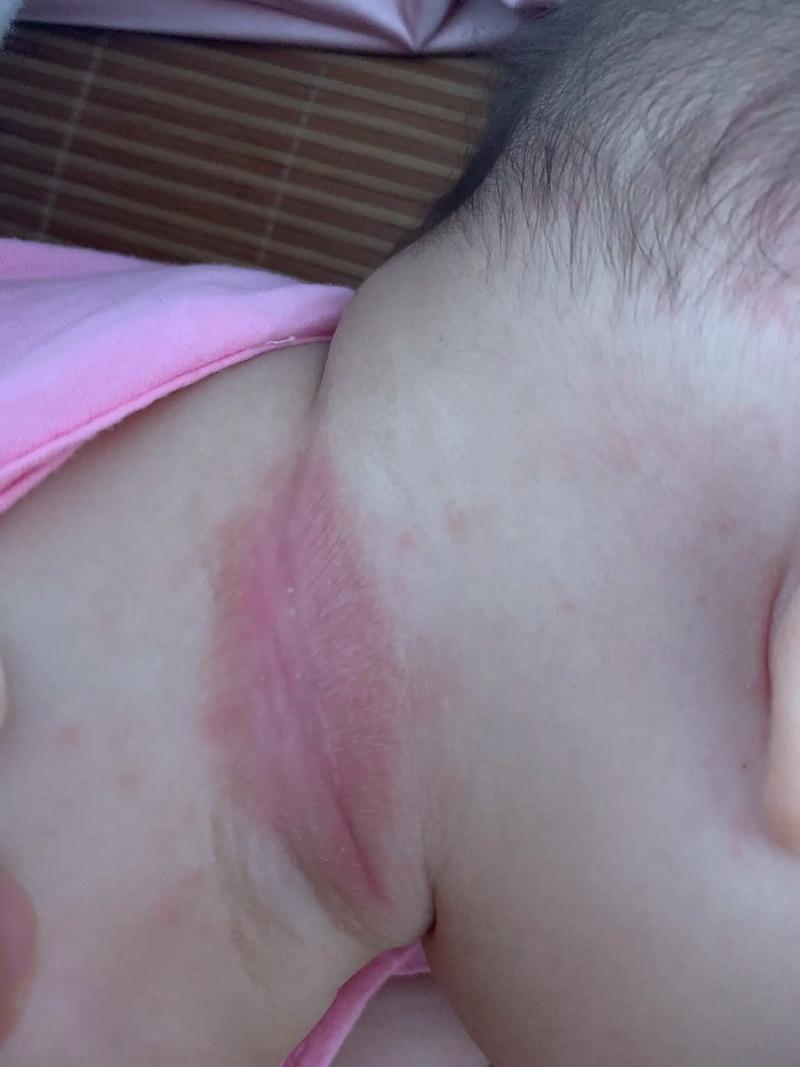 新生儿宝宝脖子长白泡是湿疹还是其他皮肤问题？需要家长如何正确护理？-第2张图片-郑州医学网