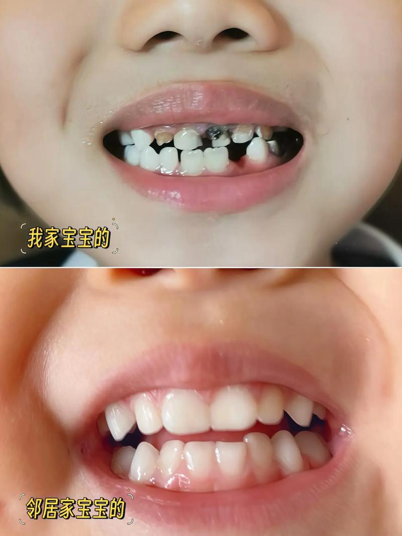 儿童牙龈发黑是正常现象还是疾病信号？需警惕哪些潜在健康风险？-第3张图片-郑州医学网