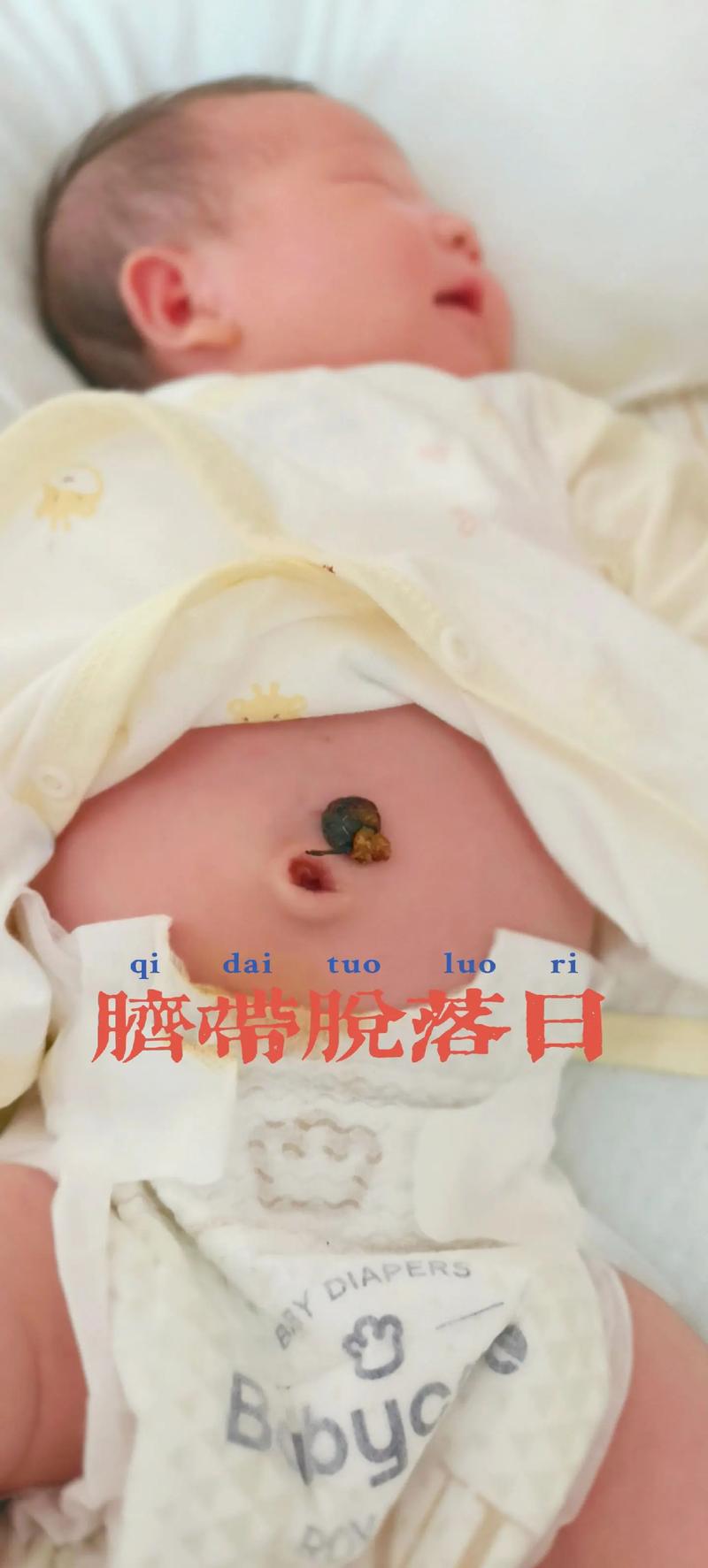 新生儿脐带脱落后出血怎么办？需要立即就医还是家庭处理？-第2张图片-郑州医学网