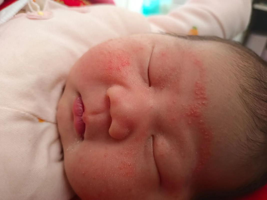 新生儿满脸红疙瘩是湿疹还是过敏？新手爸妈该如何正确护理？-第1张图片-郑州医学网